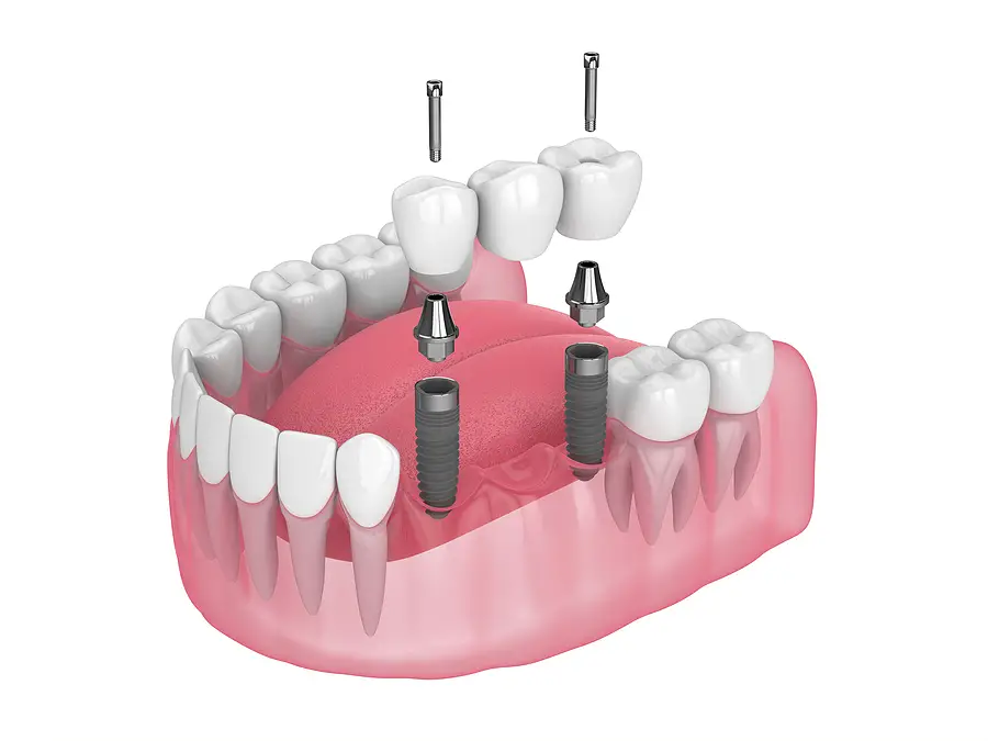 Illustration of a dental bridge procedure by IGO Dental