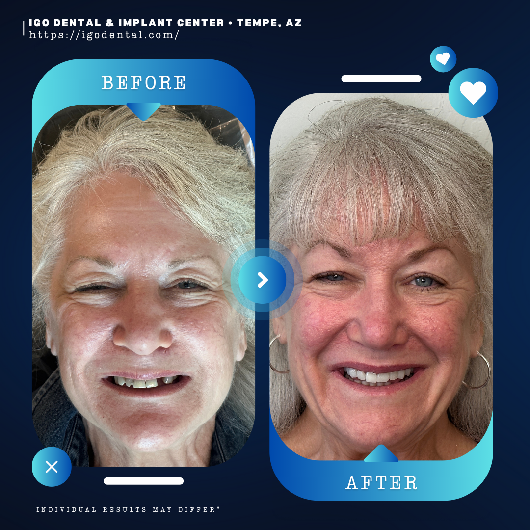 All-on-4 dental implants before and after transformation