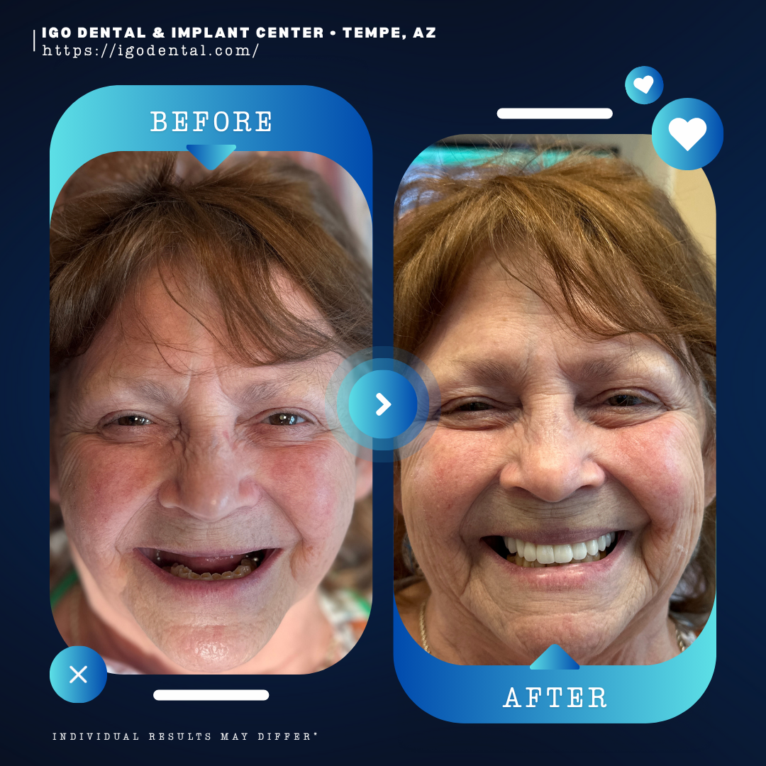 All-on-4 dental implants before and after transformation at IGO Dental