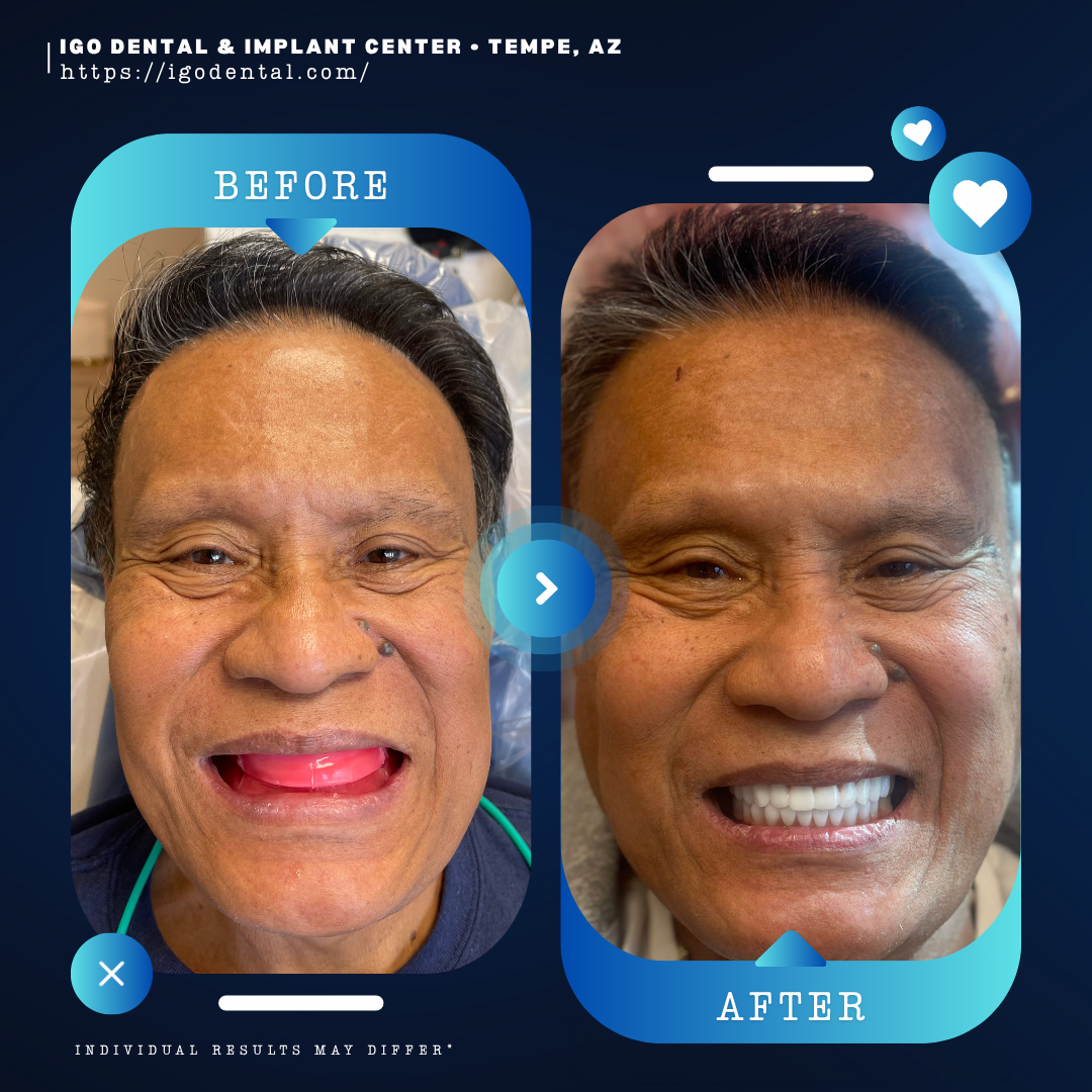 All-on-4 dental implants before and after transformation at IGO Dental