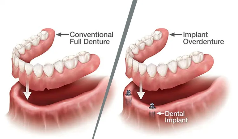 Comparison chart for dentures