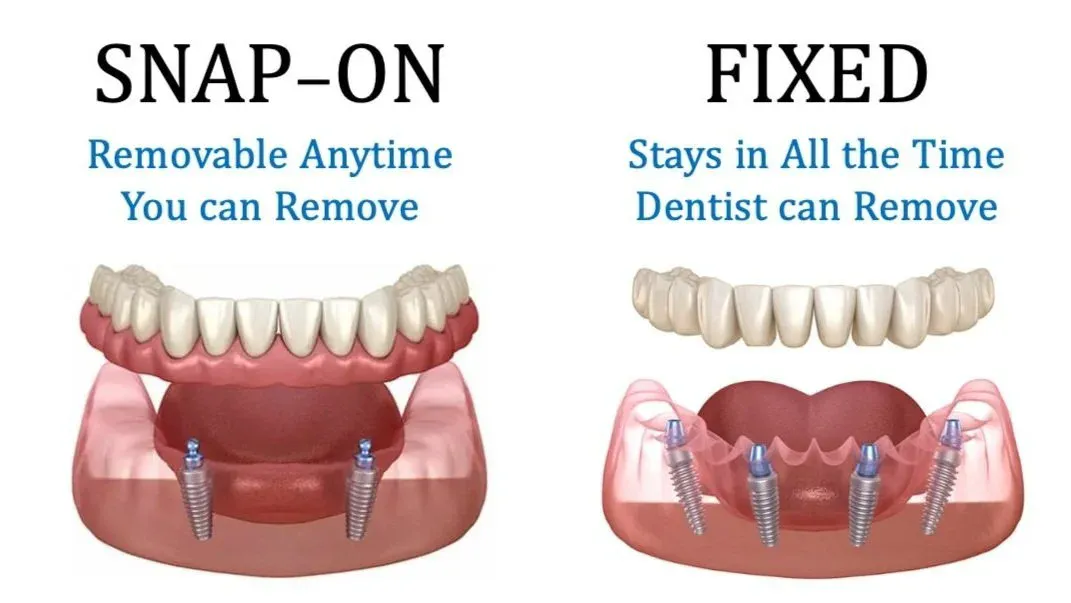 Comparison chart for all-on-4