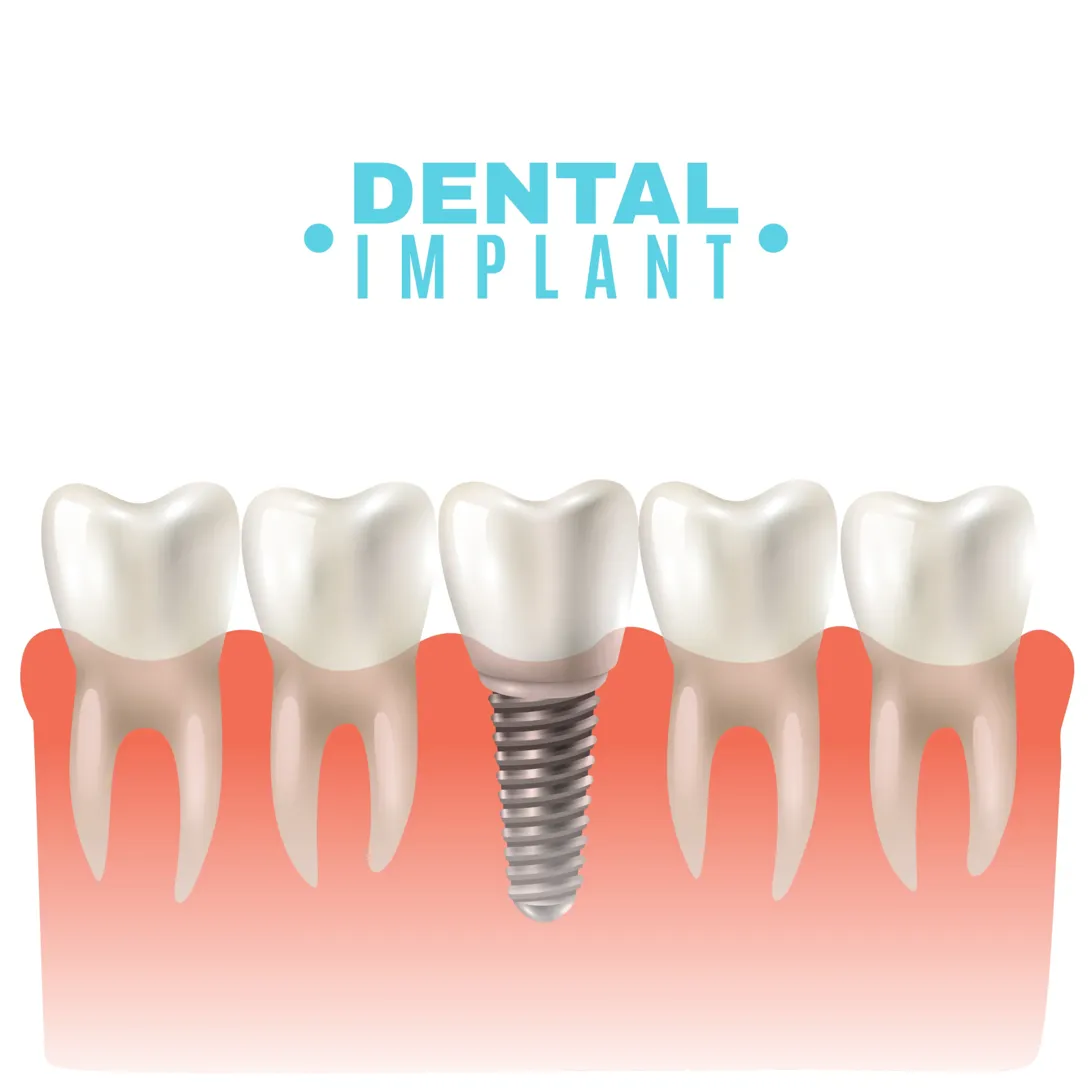 dental implants treatment - dental implants at IGO Dental Tempe