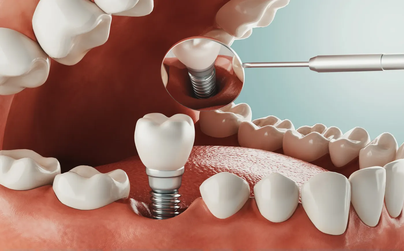 3/2 rule for dental implants treatment - dental implants at IGO Dental Tempe