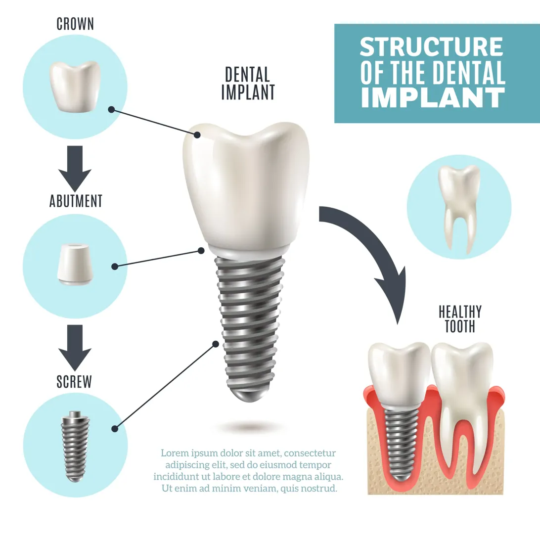 3/2 rule for dental implants structure infographic